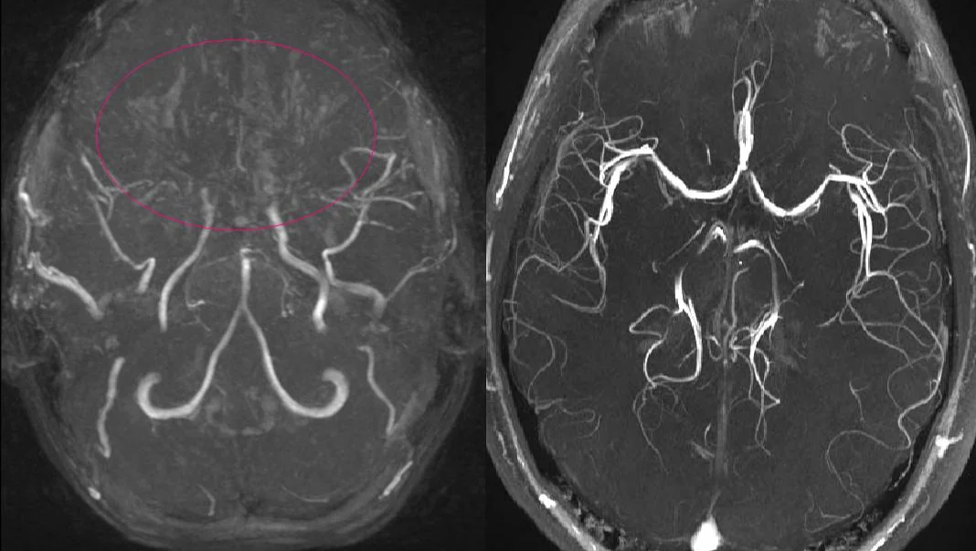 Moyamoya Hastalığı Nedir Ve Nasıl Teşhis Edilir? | Siirt Olay Haber